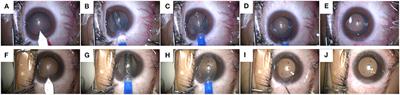 One-year Observation of Safety of Implantable Collamer Lens V4c Implantation Without Using an Ophthalmic Viscosurgical Device